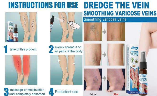 Spray para Varices